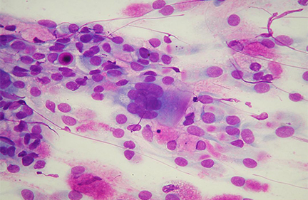 citologia nasale che cosa è multinucleazione virosi