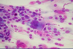 Citologia Nasale. Multinucleazione in paziente con virosi