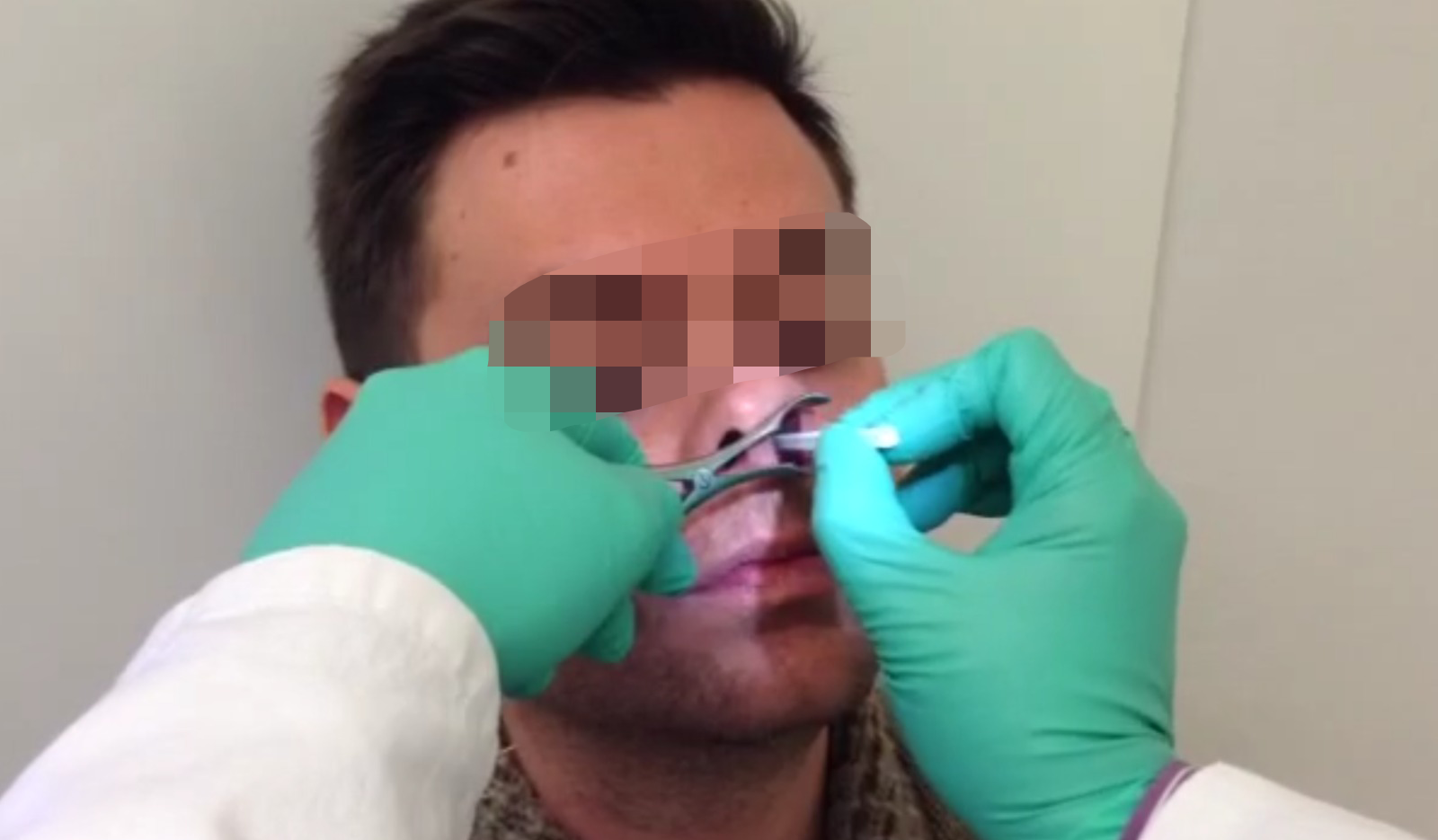 Prelievo Nasal Scraping Citologia Nasale