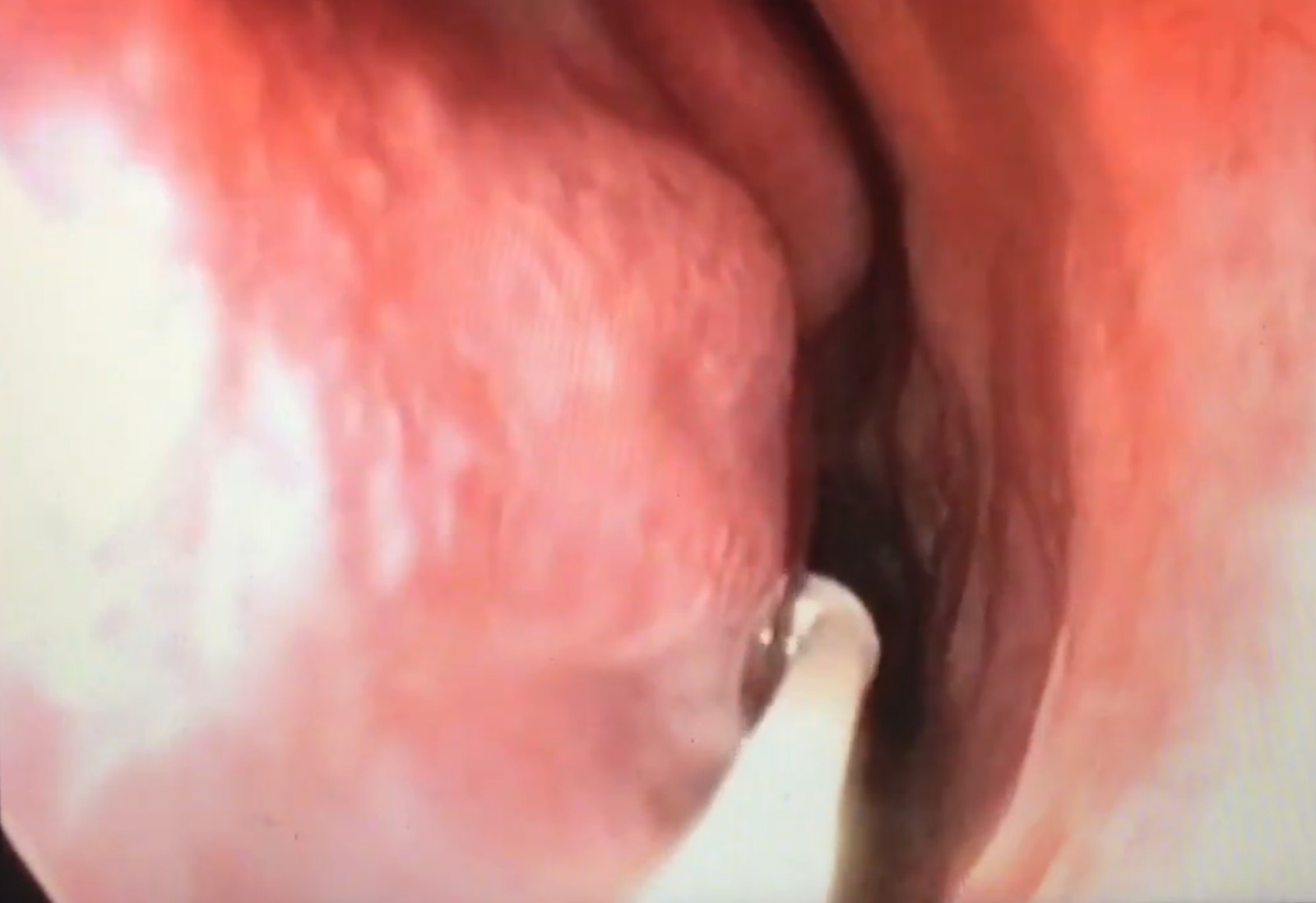 Prelievo su turbinato per citologia nasale con Nasal Scraping