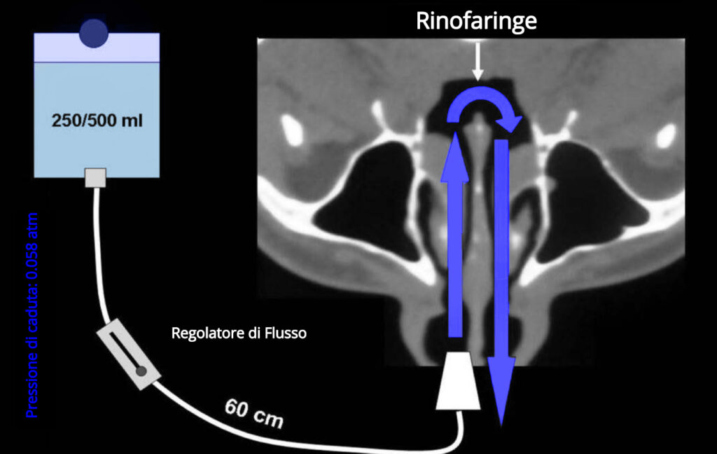 Sistema di Irrigazione Nasale NASIR