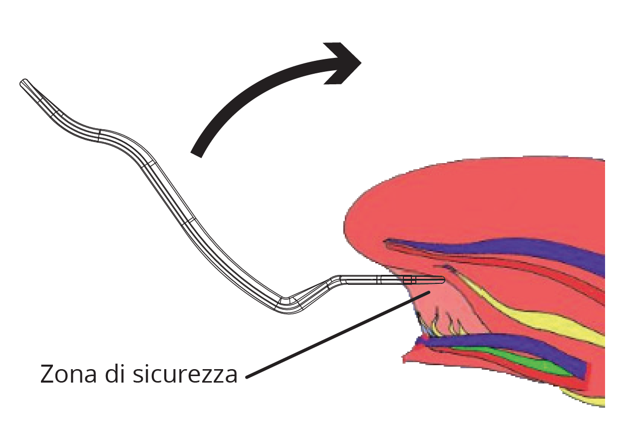 Alzalingua Frenulectomia Frenulotomia